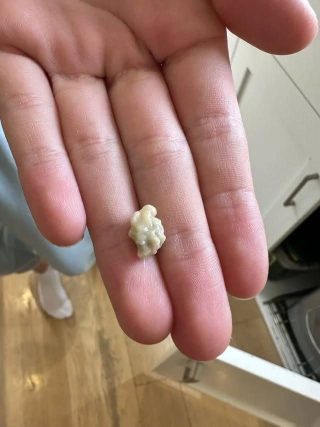 Tudo o que você precisa saber sobre cáseos amigdalianos, crescimentos estranhos que parecem espinhas na garganta.