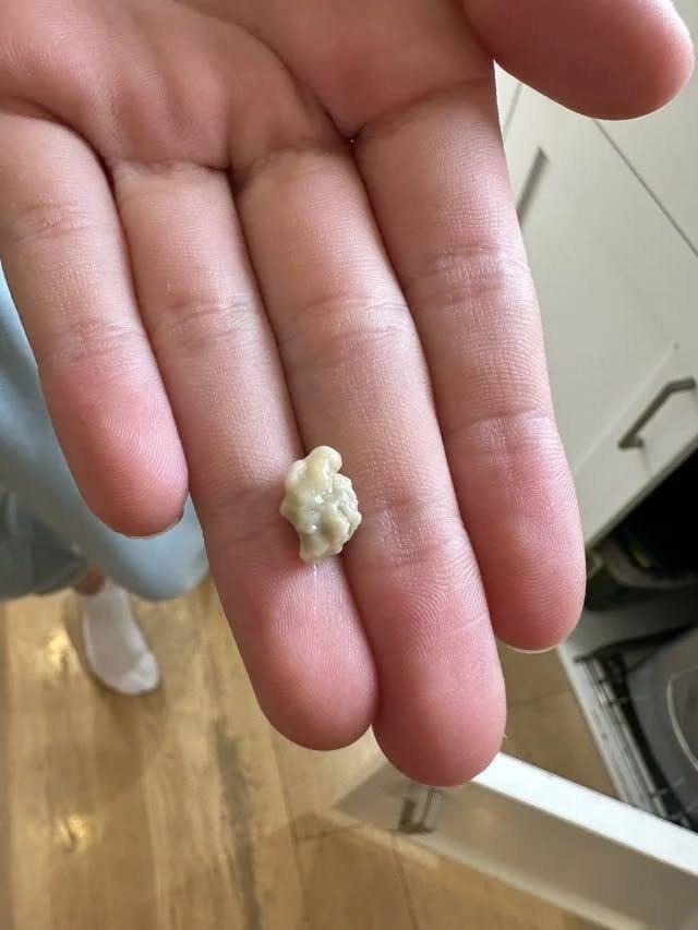 Tudo o que você precisa saber sobre cáseos amigdalianos, crescimentos estranhos que parecem espinhas na garganta.