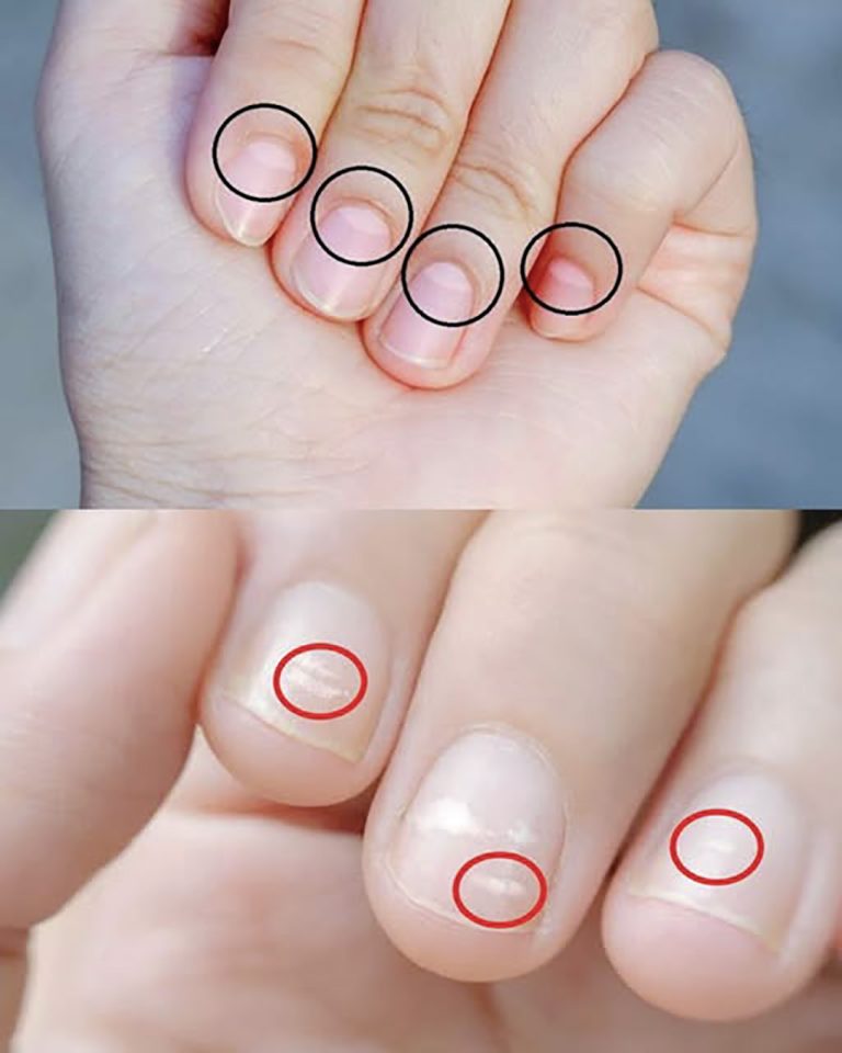 As luas crescentes nas unhas revelam nosso estado de saúde.