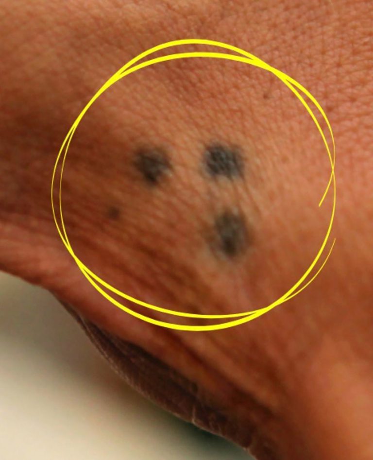 O mistério dos três pontos tatuados: um emblema com múltiplas interpretações.