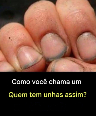 Como se chama uma pessoa que tem unhas assim?